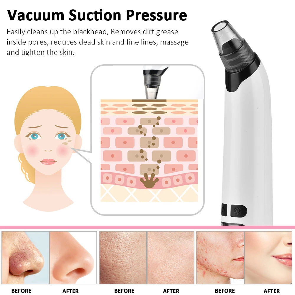 Blackhead Remover Vacuum Acne Pimple Black Spot Suction Electric Facial Pore Cleaner Skincare Exfoliating Beauty Instrument